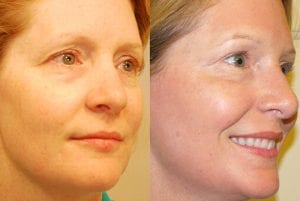 Before and After Image