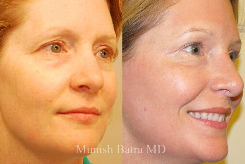 Before and After Image