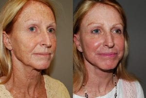 Before and After Image