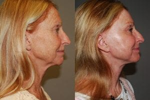 Before and After Image