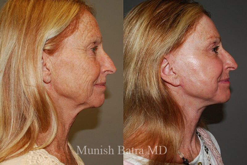 Before and After Image