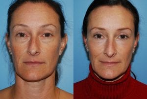 Before and After Image