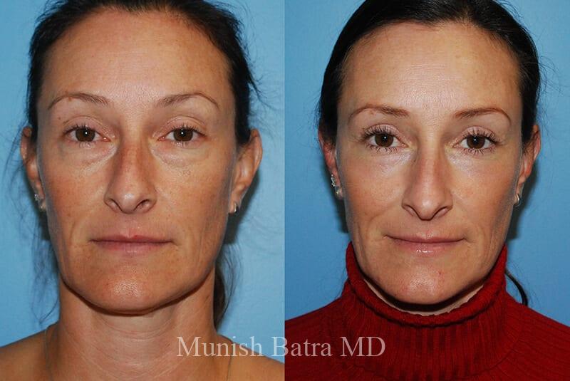 Before and After Image