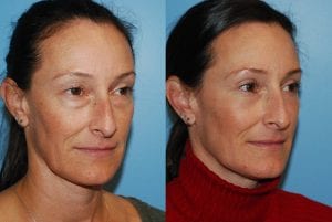 Before and After Image