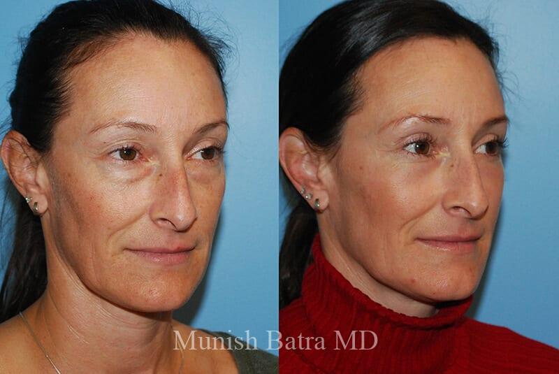 Before and After Image