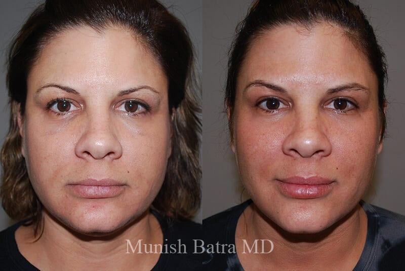 Before and After Image