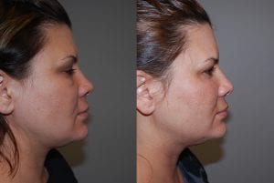 Before and After Image