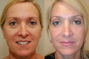 Before and After Image