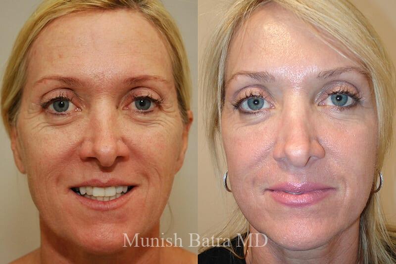 Before and After Image