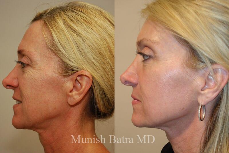 Before and After Image