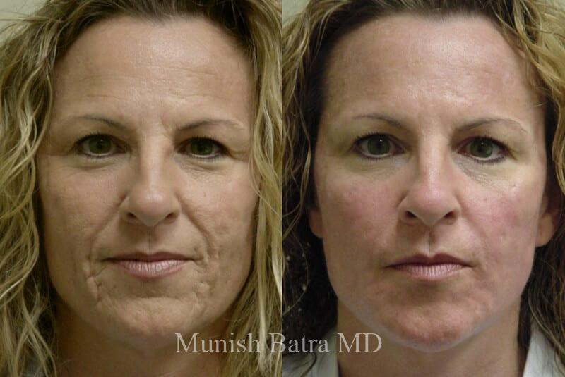 Before and After Image