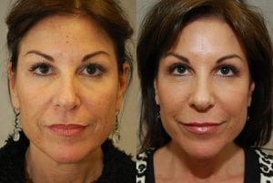 Before and After Image