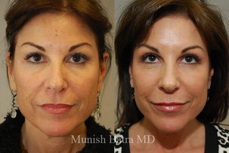 Before and After Image