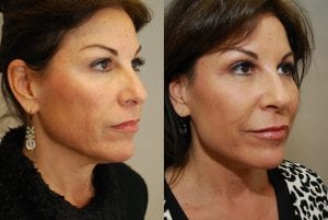 Before and After Image