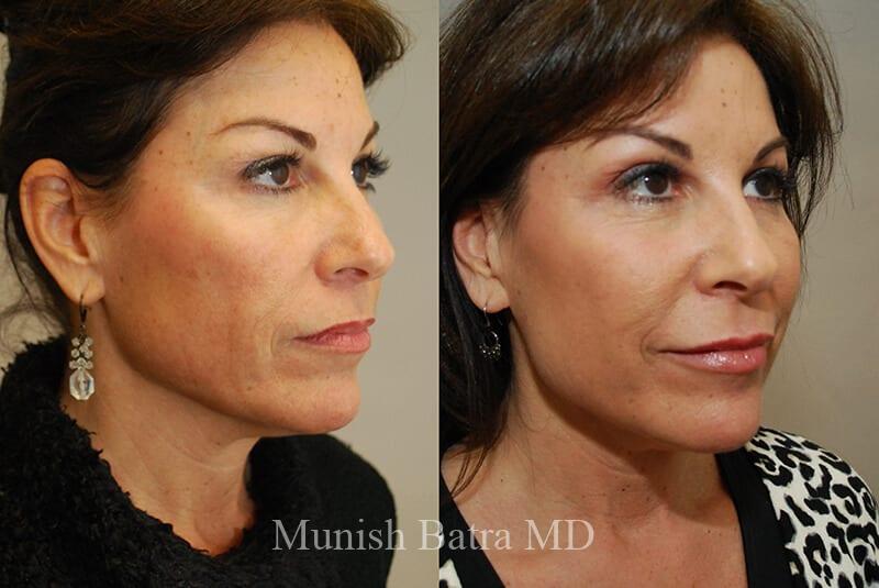 Before and After Image