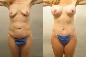 Before and After Image