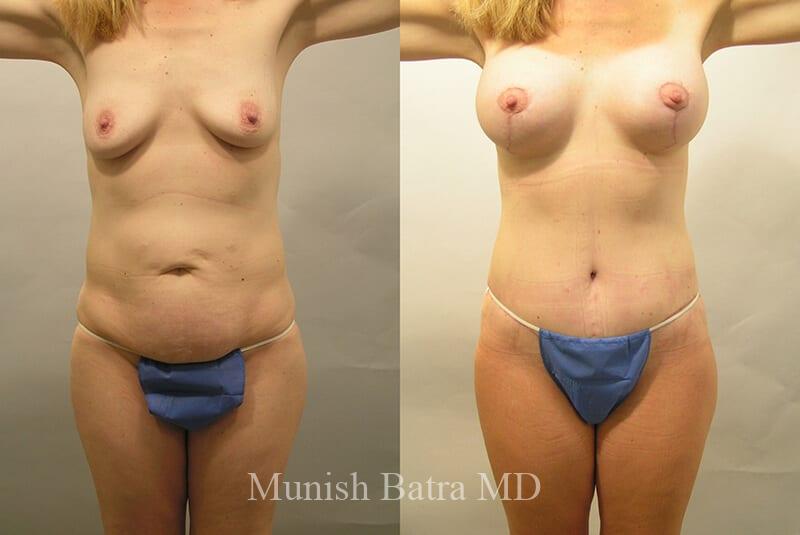 Before and After Image
