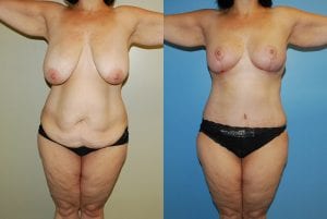 Before and After Image