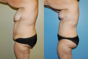 Before and After Image