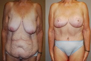 Before and After Image