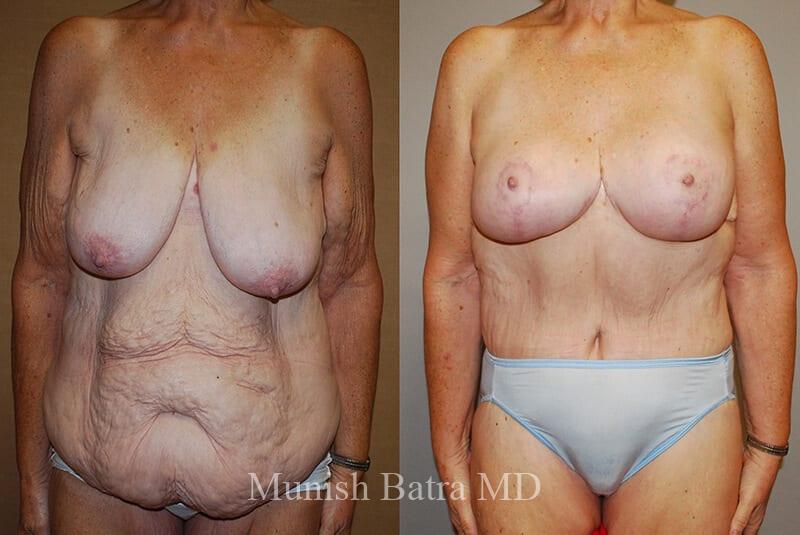 Before and After Image
