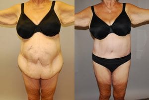 Before and After Image