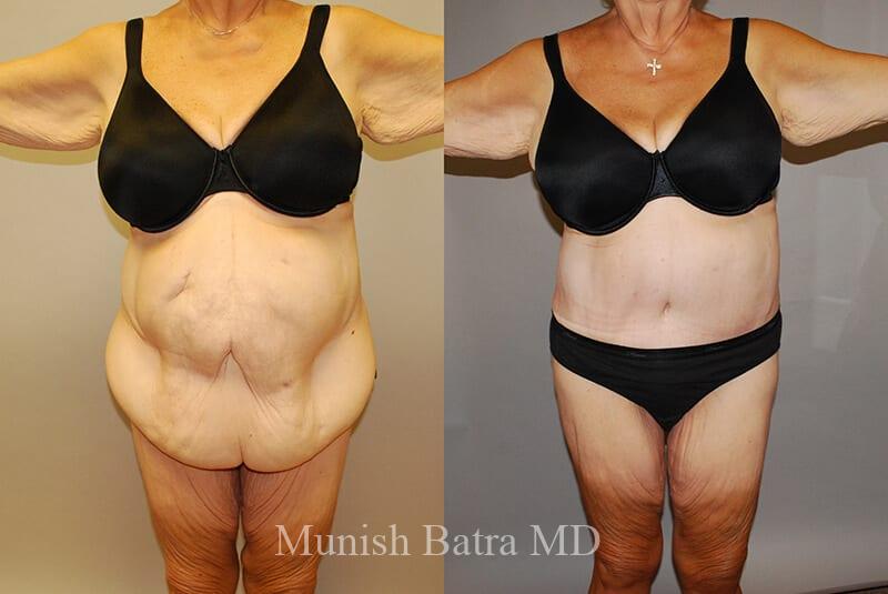 GBRX Abdominoplasty Reconstruction Patient 14 front.