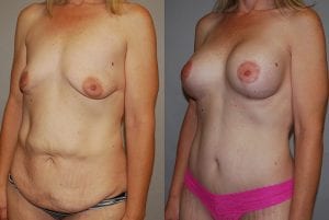 Before and After Image