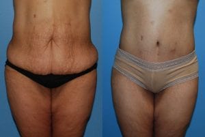Before and After Image