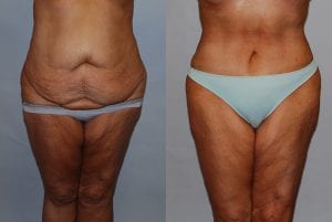 Before and After Image