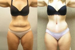Before and After Image