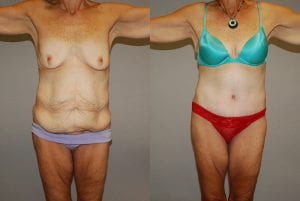 Before and After Image