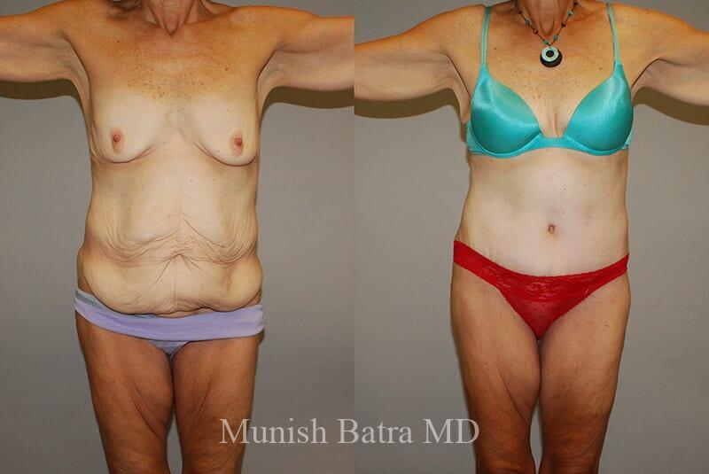 Before and After Image