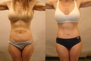Before and After Image