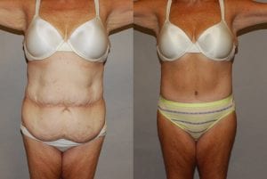Before and After Image
