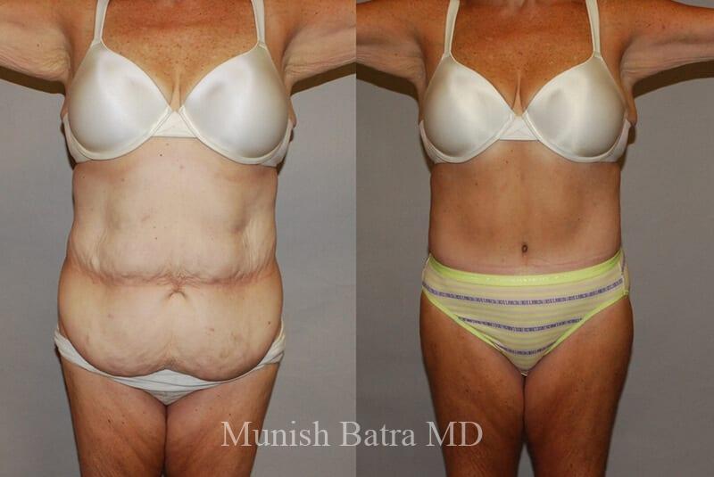 Before and After Image