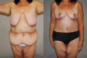 Before and After Image
