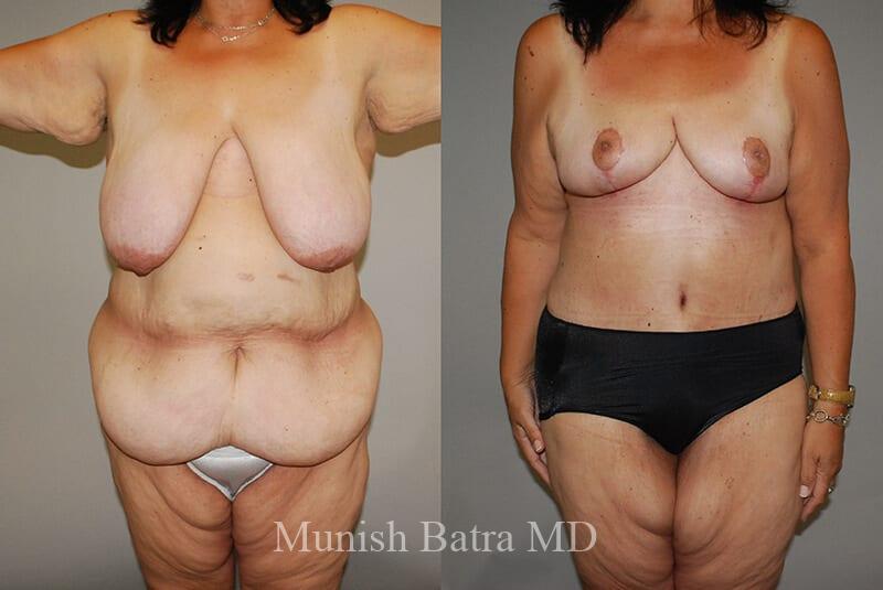 Before and After Image