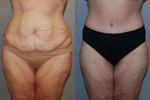 Before and After Image
