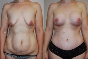 Before and After Image