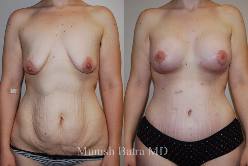 Before and After Image