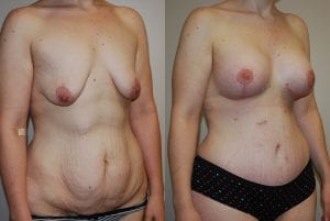 Before and After Image