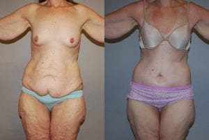 Before and After Image