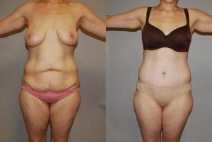 Before and After Image