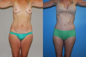 Before and After Image