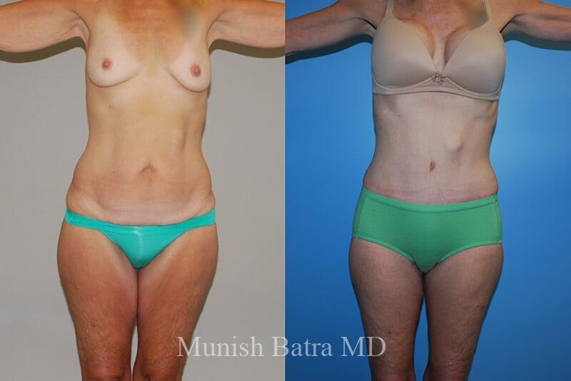 Before and After Image