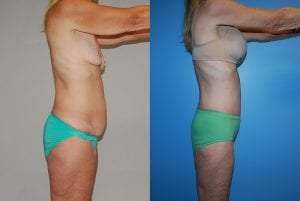 Before and After Image