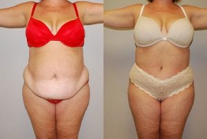 Before and After Image