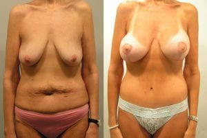 Before and After Image