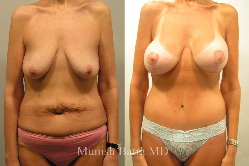 Before and After Image